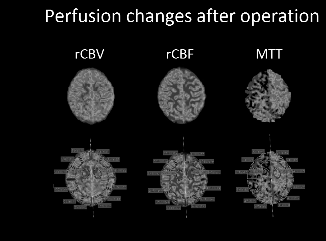 Радиология: КТ перфузия головного мозга