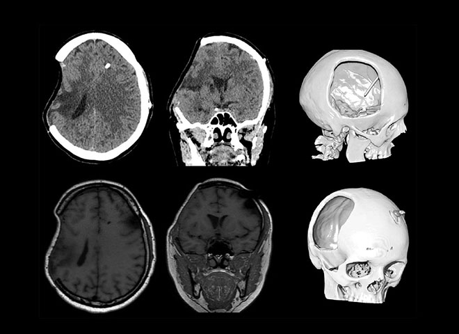 Радиология: случай парадоксальной церебральной грыжи