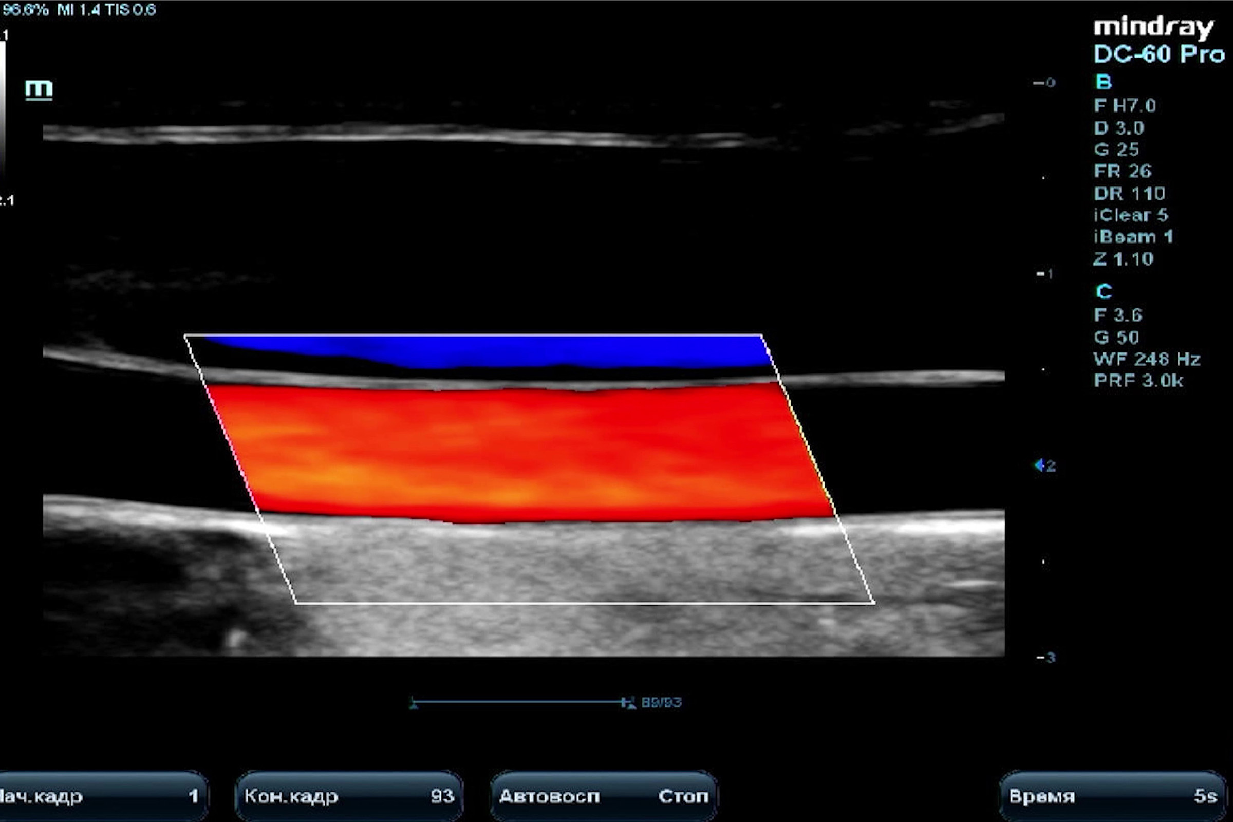 Сонные артерии на УЗИ: B-режим, Color и PW-допплер, базовая линия, комплекс интима-медиа